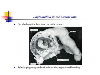 Implantation in the uterine tube 
 Decidual reaction fails to occur in the oviduct 
 Tubular pregnancy ends with the oviduct rupture and bleeding 
 