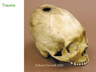 Trauma
 