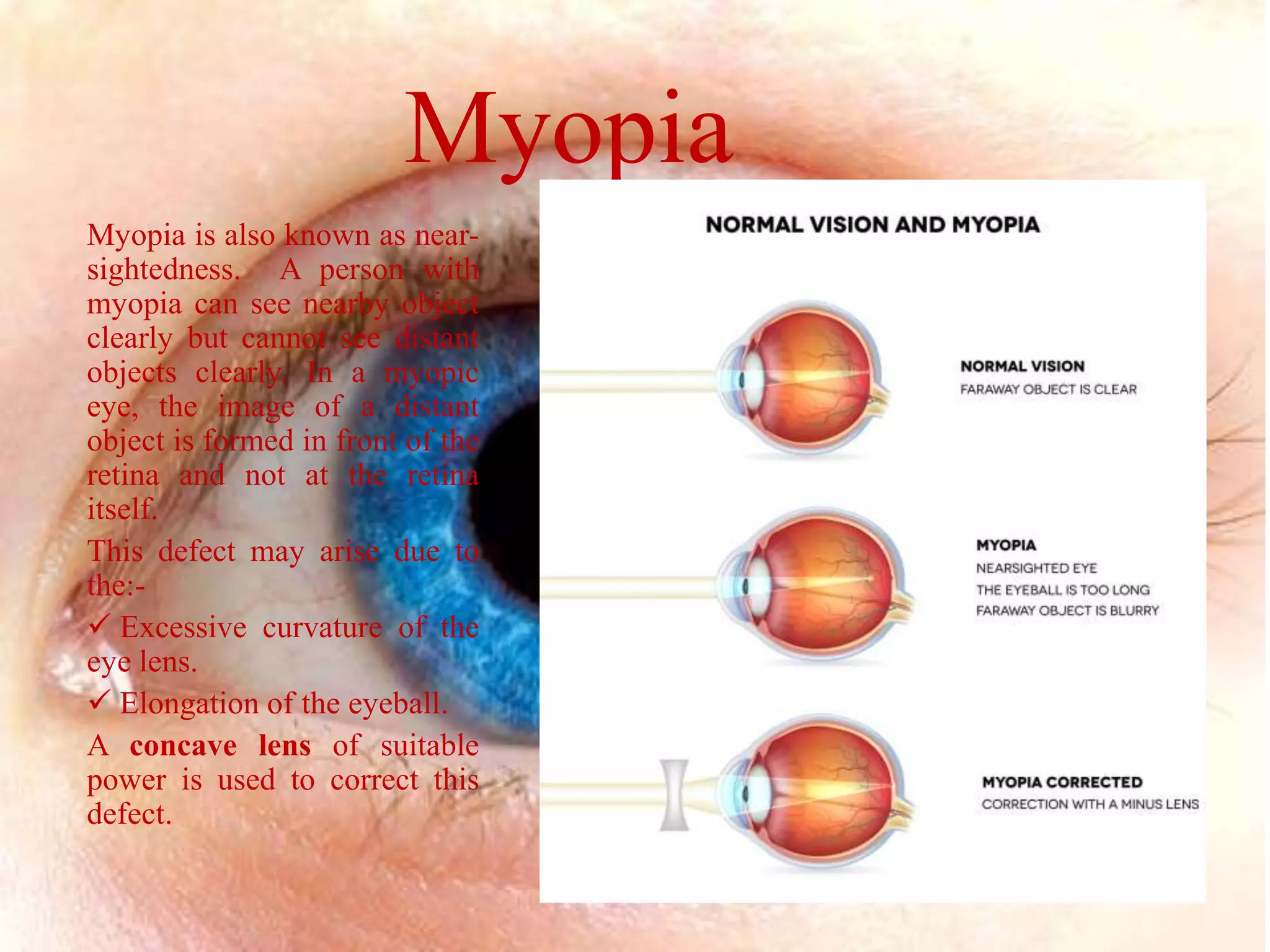 Myopy Human eye | PPTX