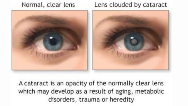Human eye and colourful world class 10 .pptx | Eye and Vision ...