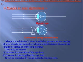 i) Myopia or near sightedness :-
Myopia is a defect of vision in which a person can see nearby
objects clearly but cannot see distant objects clearly because the
image is formed in front of the retina.
This may be due to:-
i) Increase in curvature of the eye lens
ii) Increase in the length of the eye ball
It can be corrected by using suitable concave lens.
Myopic eye
Correction using concave lens
 
