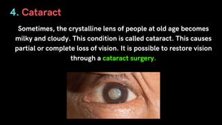 4. Cataract
Sometimes, the crystalline lens of people at old age becomes
milky and cloudy. This condition is called cataract. This causes
partial or complete loss of vision. It is possible to restore vision
through a cataract surgery.
 