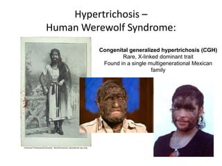 Hypertrichosis –
Human Werewolf Syndrome:
         Congenital generalized hypertrichosis (CGH)
                 Rare, X-linked dominant trait
          Found in a single multigenerational Mexican
                             family
 