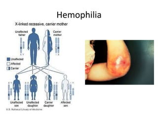 Hemophilia
 