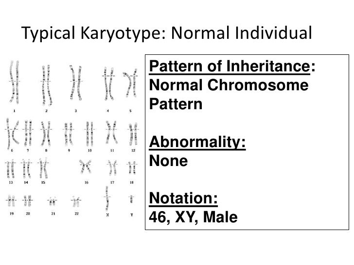 down syndrome genetics abnormality essay Essay about hypoplastic left heart syndrome it is also the most common chromosome abnormality in humans history of down's syndrome essay down’s syndrome . down syndrome genetics abnormality essay Essay about hypoplastic left heart syndrome it is also the most common chromosome abnormality in humans history of down's syndrome essay down’s syndrome .