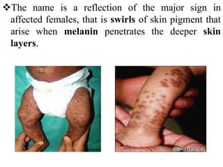 The name is a reflection of the major sign in
affected females, that is swirls of skin pigment that
arise when melanin penetrates the deeper skin
layers.
 