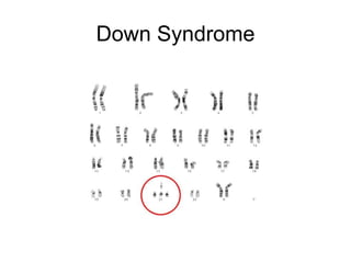 Down Syndrome 