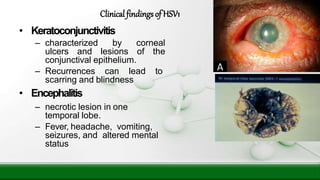 • Keratoconjunctivitis
– characterized by corneal
ulcers and lesions of the
conjunctival epithelium.
– Recurrences can lead to
scarring and blindness
• Encephalitis
– necrotic lesion in one
temporal lobe.
– Fever, headache, vomiting,
seizures, and altered mental
status
Clinical findingsof HSV1
 