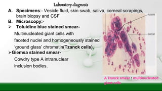 A. Specimens:- Vesicle fluid, skin swab, saliva, corneal scrapings,
brain biopsy and CSF
B. Microscopy:-
 Toluidine blue stained smear-
Multinucleated giant cells with
faceted nuclei and homogeneously stained
‘ground glass’ chromatin(Tzanck cells).
Giemsa stained smear-
Cowdry type A intranuclear
inclusion bodies.
Laboratorydiagnosis
A Tzanck smear : multinucleated
giant cells
 