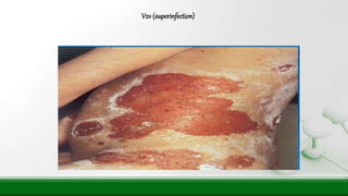 Vzv (superinfection)
 