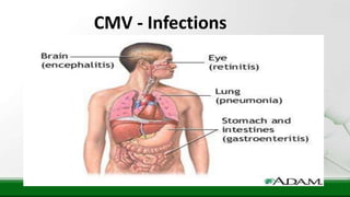 CMV - Infections
 
