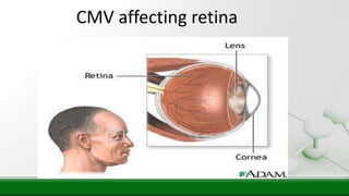 CMV affecting retina
 
