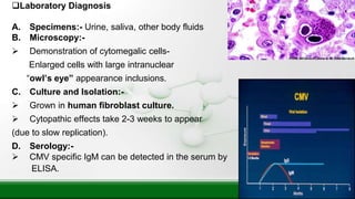 Laboratory Diagnosis
A. Specimens:- Urine, saliva, other body fluids
B. Microscopy:-
 Demonstration of cytomegalic cells-
Enlarged cells with large intranuclear
“owl’s eye” appearance inclusions.
C. Culture and Isolation:-
 Grown in human fibroblast culture.
 Cytopathic effects take 2-3 weeks to appear
(due to slow replication).
D. Serology:-
 CMV specific IgM can be detected in the serum by
ELISA.
 