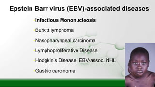 Epstein Barr virus (EBV)-associated diseases
•Infectious Mononucleosis
•Burkitt lymphoma
•Nasopharyngeal carcinoma
•Lymphoproliferative Disease
•Hodgkin’s Disease, EBV-assoc. NHL
•Gastric carcinoma
 