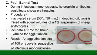 C. Paul- Bunnel Test
 During infectious mononucleosis, heterophile antibodies
agglutinate sheep erythrocytes.
 Procedure:-
• Inactivated serum (56°c/ 30 min.) in doubling dilutions is
mixed with equal volumes of a 1% suspension of sheep
erythrocytes.
• Incubate at 37°c for 1hour
• Examine for agglutination.
 Result:- An agglutination titre
of 100 or above is suggestive
of infectious mononucleosis.
+ve -ve
 