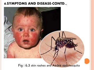 6.SYMPTOMS AND DISEASE-CONTD..,
Fig : 6.3 skin rashes and Aedes spp mosquito
 