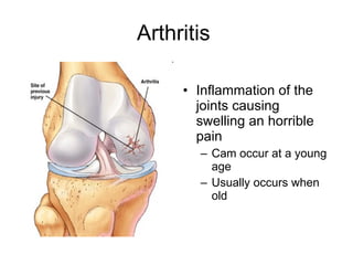 Arthritis Inflammation of the joints causing swelling an horrible pain Cam occur at a young age Usually occurs when old