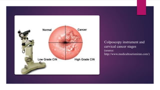 Colposcopy instrument and
cervical cancer stages
(source:
http://www.medicaltourismiran.com/)
 