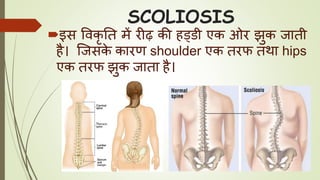 SCOLIOSIS
इस ववकृ तत में रीढ़ की हड्डी एक ओर झुक जाती
है। जजसके कारण shoulder एक तरफ तथा hips
एक तरफ झुक जाता है।
 