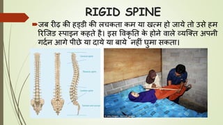 RIGID SPINE
जब रीढ़ की हड्डी की लचकता कम या खत्म हो जाये तो उसे हम
ररजजड स्पाइन कहते है। इस ववकृ तत के होने वाले व्यजतत अपनी
गदघन आगे पीछे या दाये या बाये नहीं र्ुमा सकता।
 