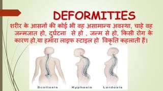 DEFORMITIES
शरीर के आसनों की कोई भी वह असामान्य अवस्था, चाहे वह
जन्मजात हो, दुर्घटना से हो , जन्म से हो, ककसी रोग के
कारण हो,या हमारा लाइफ स्टाइल हो ववकृ तत कहलाती हैं।
 