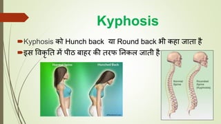Kyphosis
Kyphosis को Hunch back या Round back भी कहा जाता है
इस ववकृ तत में पीठ बाहर की तरफ तनकल जाती है
 