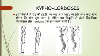 KYPHO-LORDOSIS
इस ववकृ तत में रीढ़ की हड्डी का कु छ भाग बाहर की ओर तथा कु छ भाग
भीतर की ओर र्ुस जाता है अथाघत इस ववकृ तत में दोनों ववकृ ततया
कीफोससस और lordosis एक साथ पायी जाती है।
 