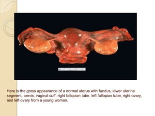 Here is the gross appearance of a normal uterus with fundus, lower uterine
segment, cervix, vaginal cuff, right fallopian tube, left fallopian tube, right ovary,
and left ovary from a young woman.

 