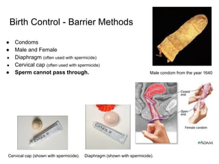 Birth Control - Barrier Methods
● Condoms
● Male and Female
● Diaphragm (often used with spermicide)
● Cervical cap (often used with spermicide)
● Sperm cannot pass through. Male condom from the year 1640
Cervical cap (shown with spermicide). Diaphragm (shown with spermicide).
 