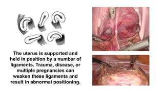 The uterus is supported and
held in position by a number of
ligaments. Trauma, disease, or
multiple pregnancies can
weaken these ligaments and
result in abnormal positioning.
 