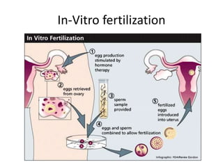 In-Vitro fertilization
 