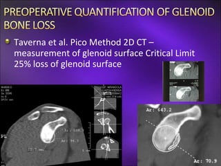 Taverna et al. Pico Method 2D CT –
measurement of glenoid surface Critical Limit
25% loss of glenoid surface
 