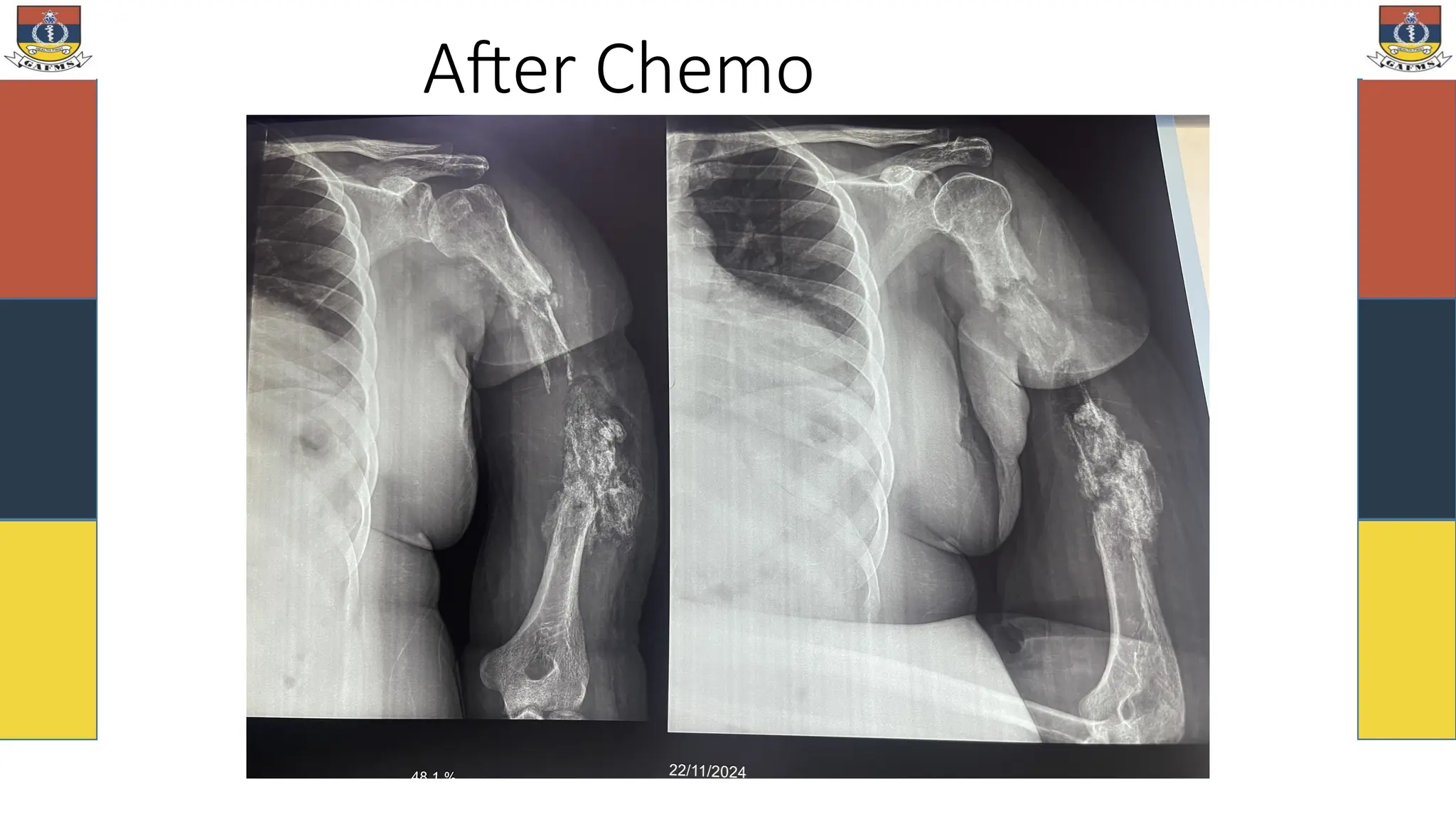 After Chemo
 
