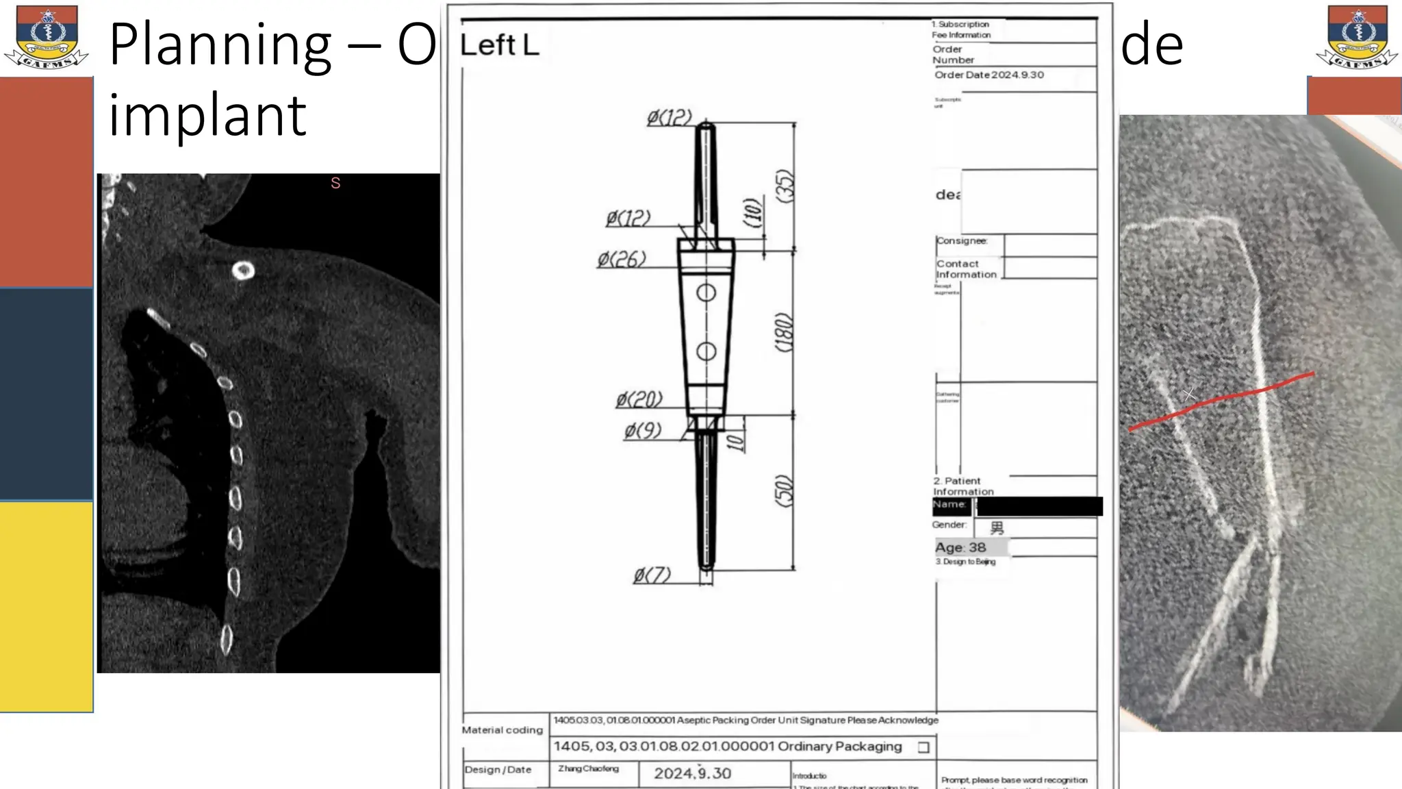 Planning – Osteotomy and Custom-made
implant
 