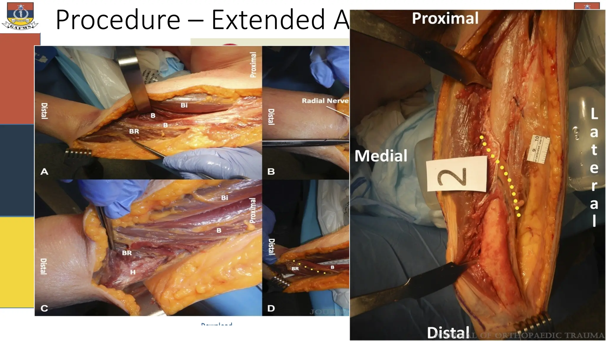 Procedure – Extended AAA
 