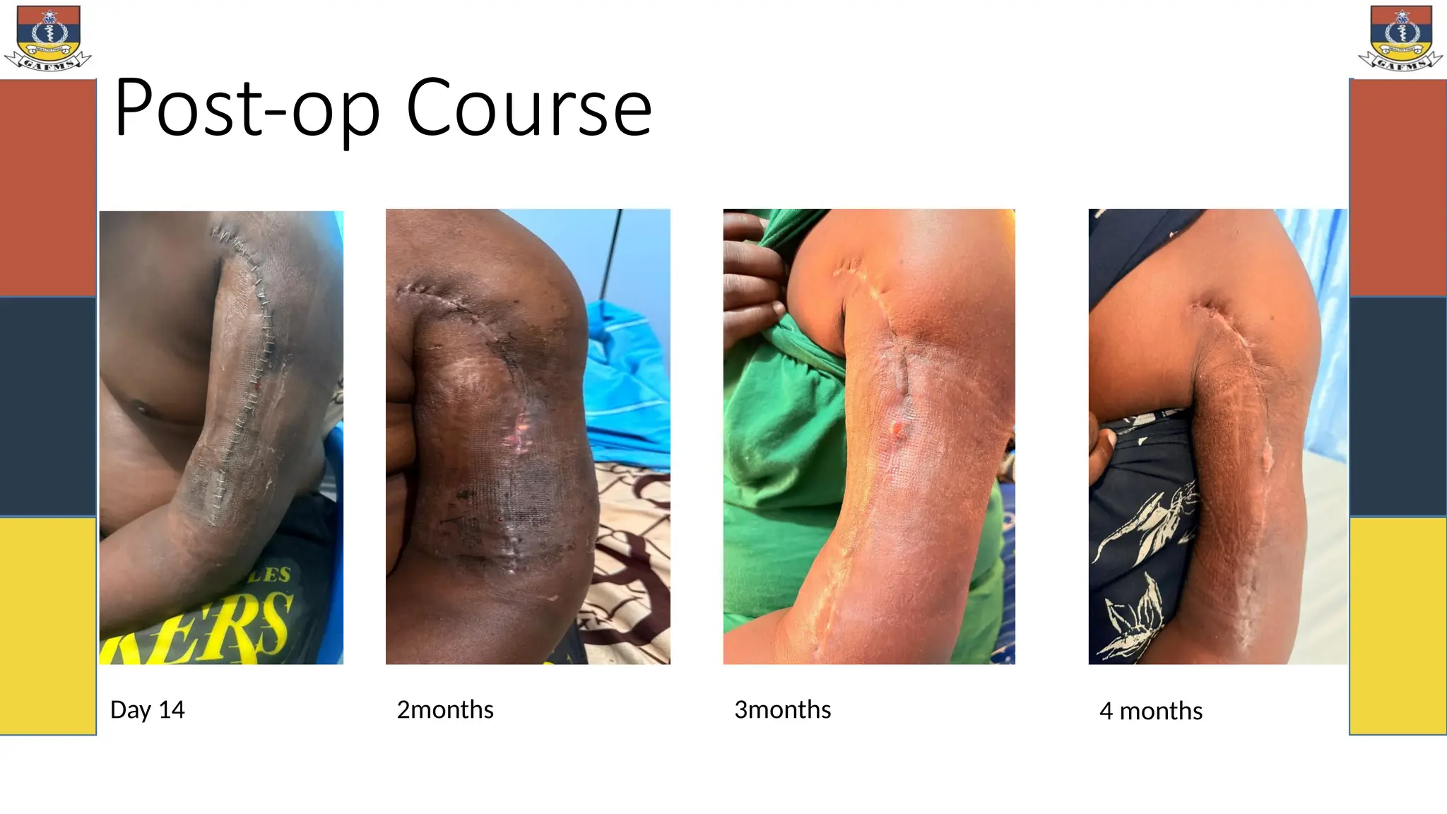 Post-op Course
Day 14 2months 4 months
3months
 