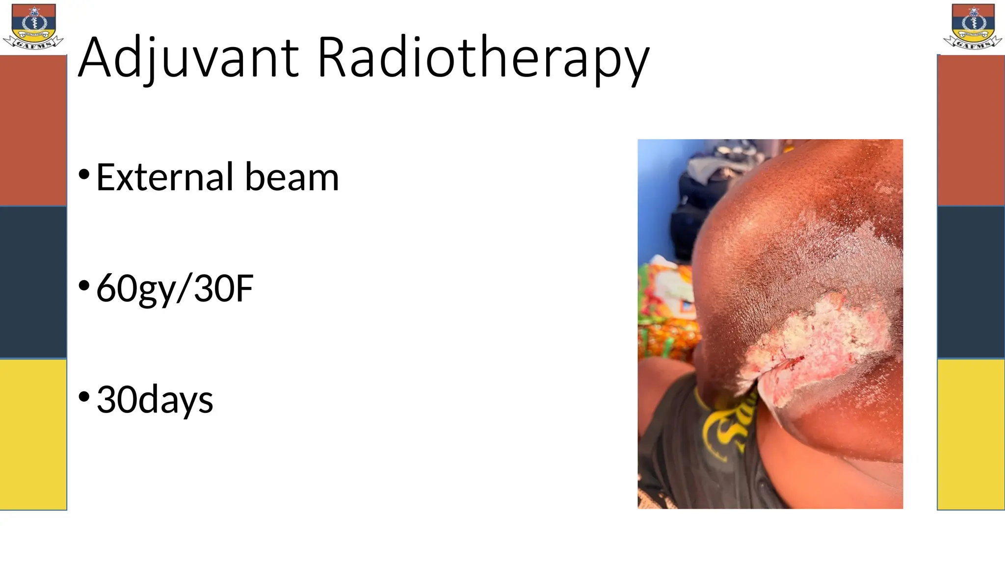 Adjuvant Radiotherapy
•External beam
•60gy/30F
•30days
 