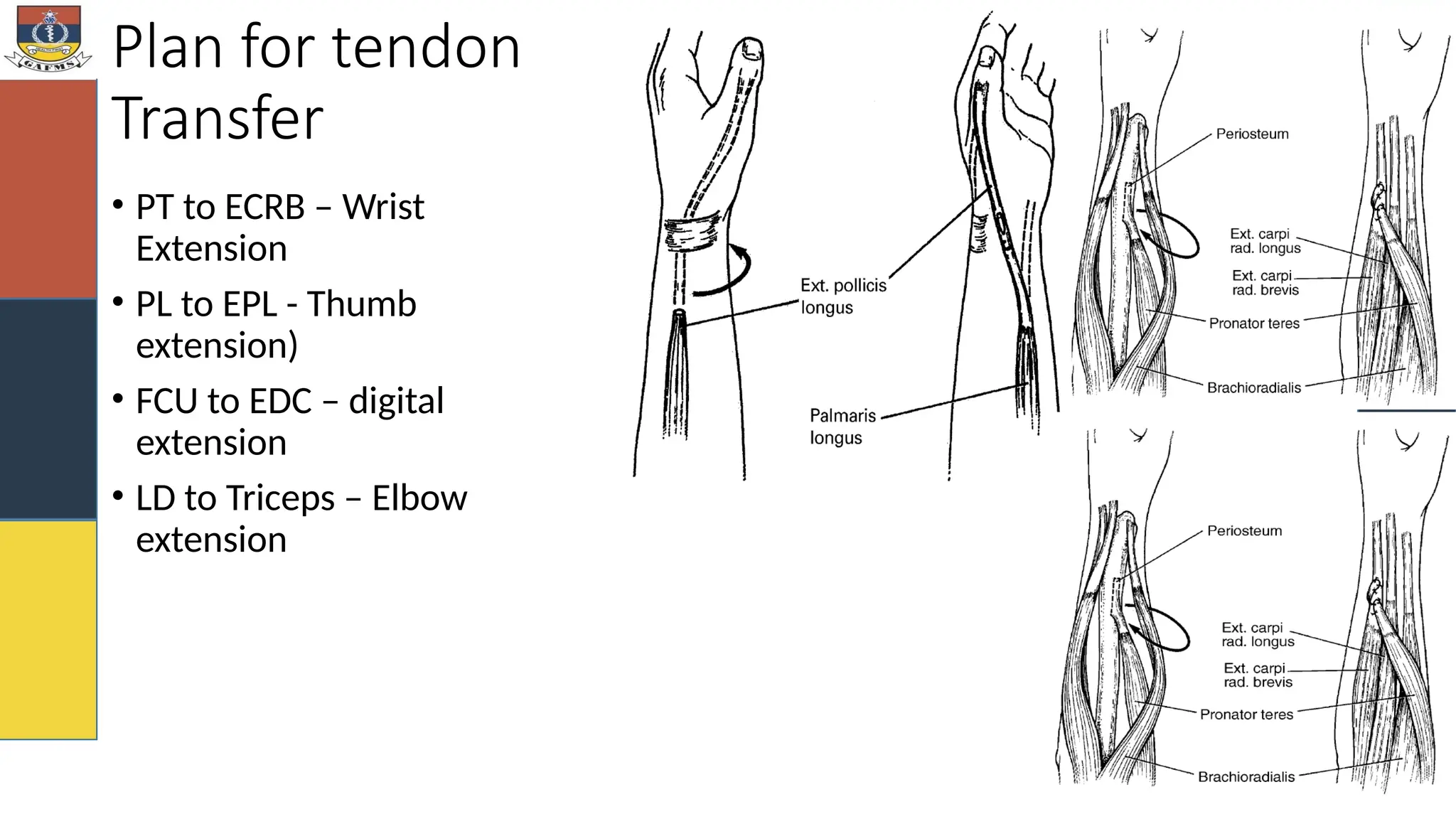 Plan for tendon
Transfer
• PT to ECRB – Wrist
Extension
• PL to EPL - Thumb
extension)
• FCU to EDC – digital
extension
• LD to Triceps – Elbow
extension
 
