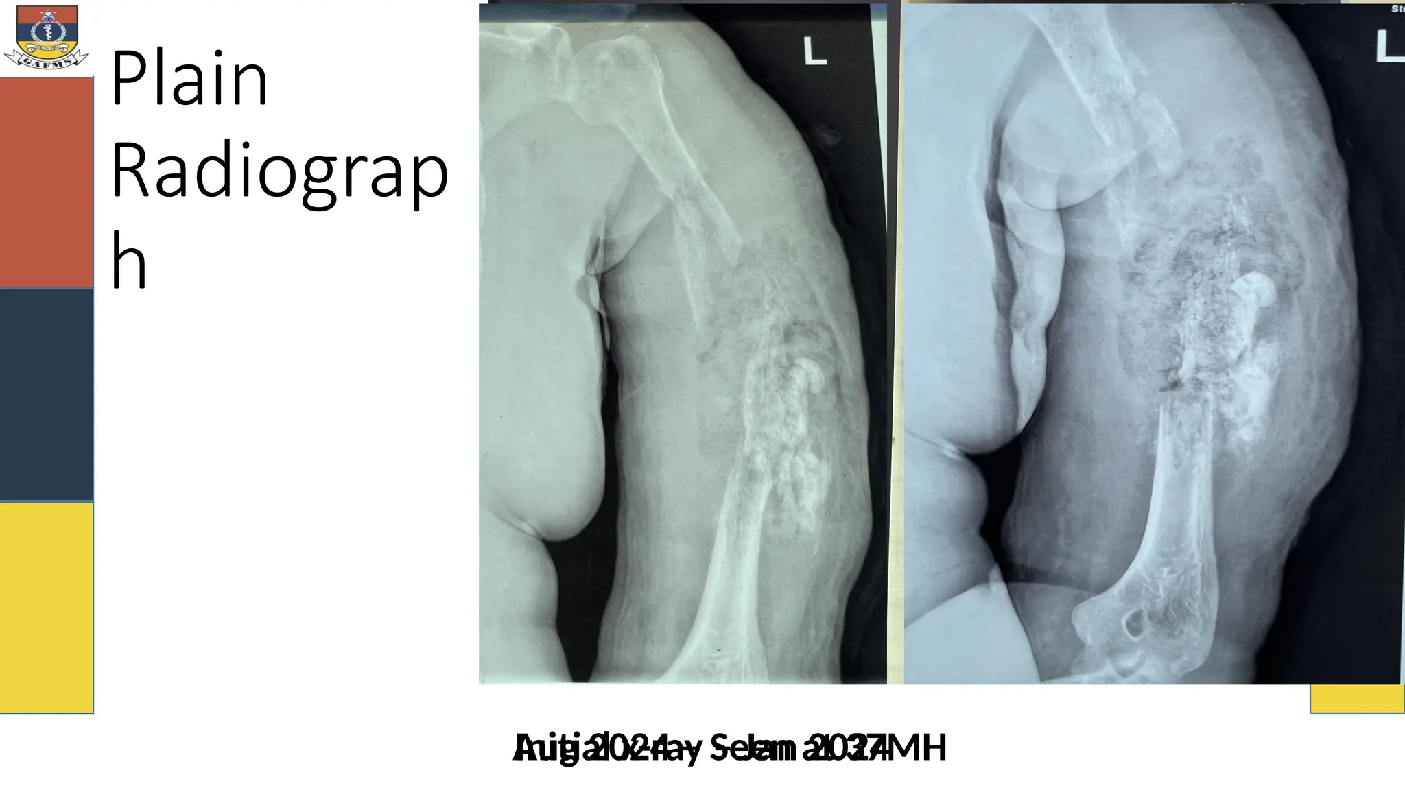 Plain
Radiograp
h
Initial x-ray – Jan 2024
Aug 2024 – Seen at 37MH
 
