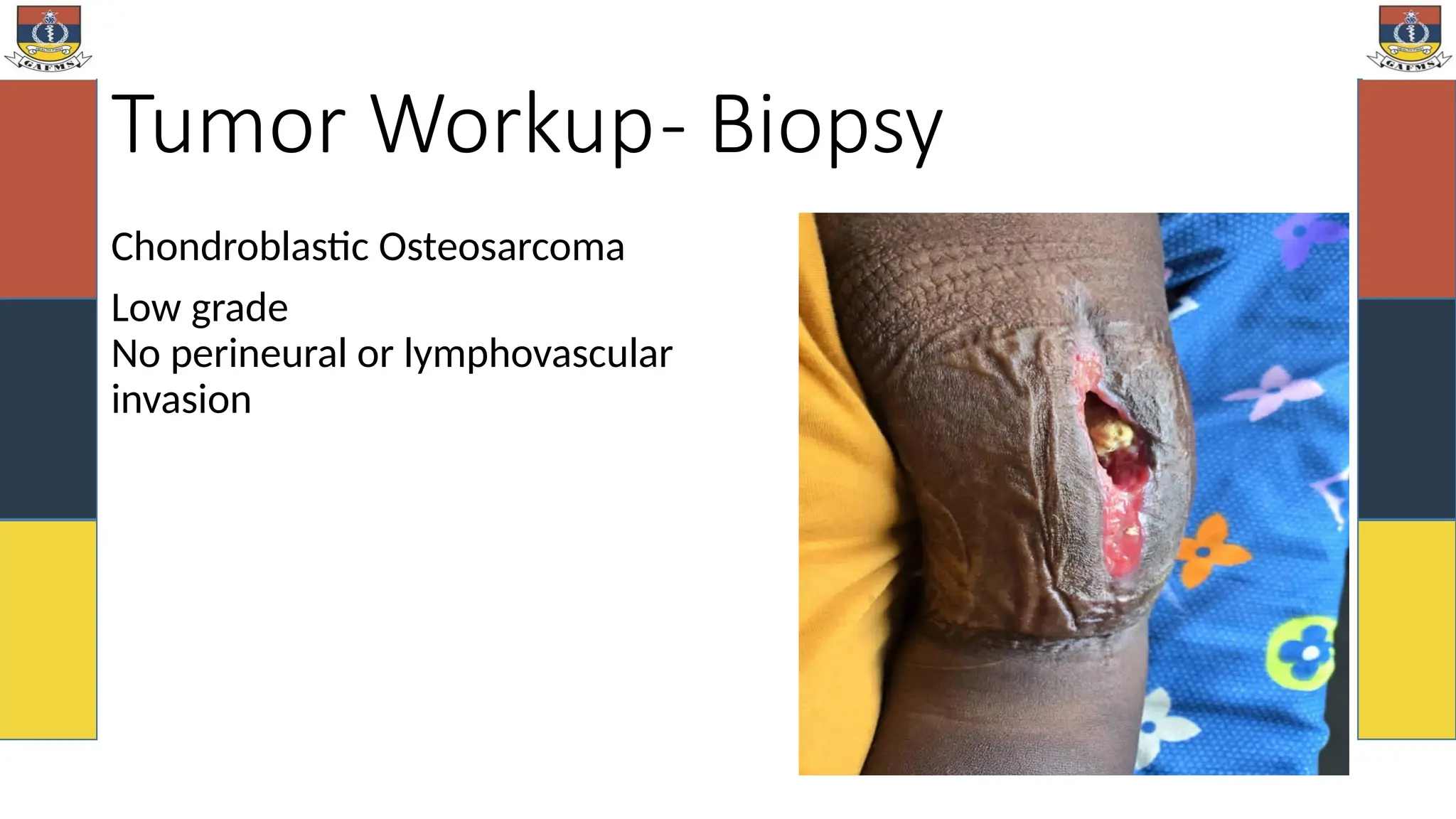 Tumor Workup- Biopsy
Chondroblastic Osteosarcoma
Low grade
No perineural or lymphovascular
invasion
 