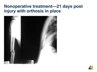 Nonoperative treatment—21 days post
injury with orthosis in place
 