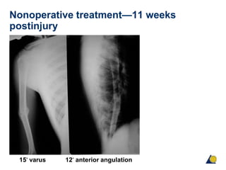 Nonoperative treatment—11 weeks
postinjury
15° varus 12° anterior angulation
 