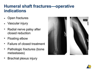 Humeral shaft fractures—operative
indications
•
•
•
Open fractures
Vascular injury
Radial nerve palsy after
closed reduction
Floating elbow
Failure of closed treatment
Pathologic fractures (bone
metastases)
Brachial plexus injury
•
•
•
•
 