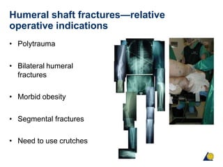 Humeral shaft fractures—relative
operative indications
• Polytrauma
• Bilateral humeral
fractures
• Morbid obesity
• Segmental fractures
• Need to use crutches
 