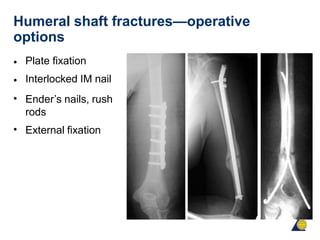 Humeral shaft fractures—operative
options
•
•
•
Plate fixation
Interlocked IM nail
Ender’s nails, rush
rods
External fixation
•
 