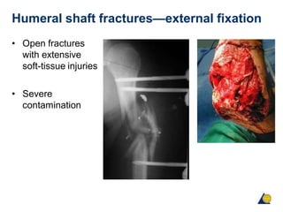 Humeral shaft fractures—external fixation
• Open fractures
with extensive
soft-tissue injuries
• Severe
contamination
 