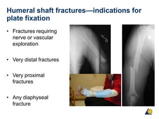Humeral shaft fractures—indications for
plate fixation
• Fractures requiring
nerve or vascular
exploration
• Very distal fractures
• Very proximal
fractures
• Any diaphyseal
fracture
 
