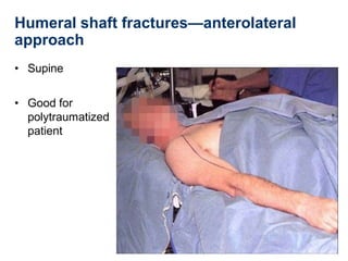 Humeral shaft fractures—anterolateral
approach
• Supine
• Good for
polytraumatized
patient
 