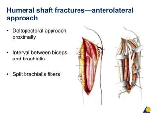 Humeral shaft fractures—anterolateral
approach
• Deltopectoral approach
proximally
• Interval between biceps
and brachialis
• Split brachialis fibers
 