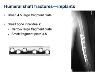Humeral shaft fractures—implants
• Broad 4.5 large fragment plate
• Small bone individuals:
-
-
Narrow large fragment plate
Small fragment plate 3.5
 